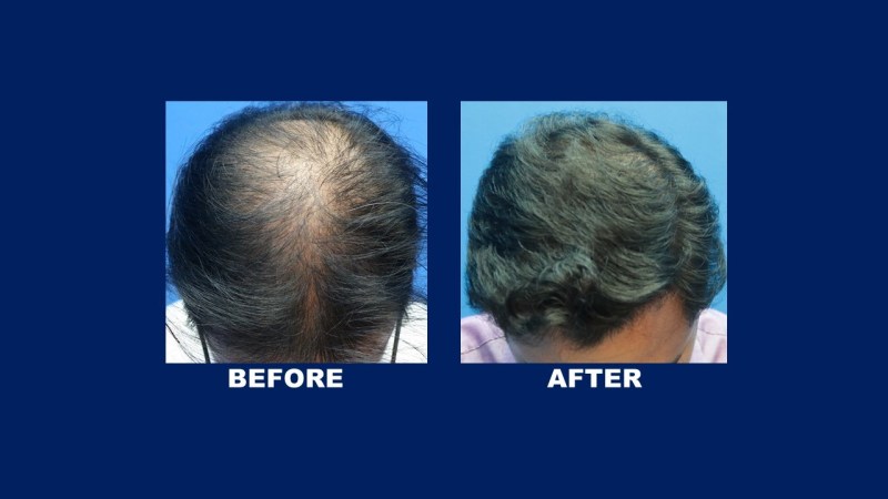 fue male result for hair transplant
