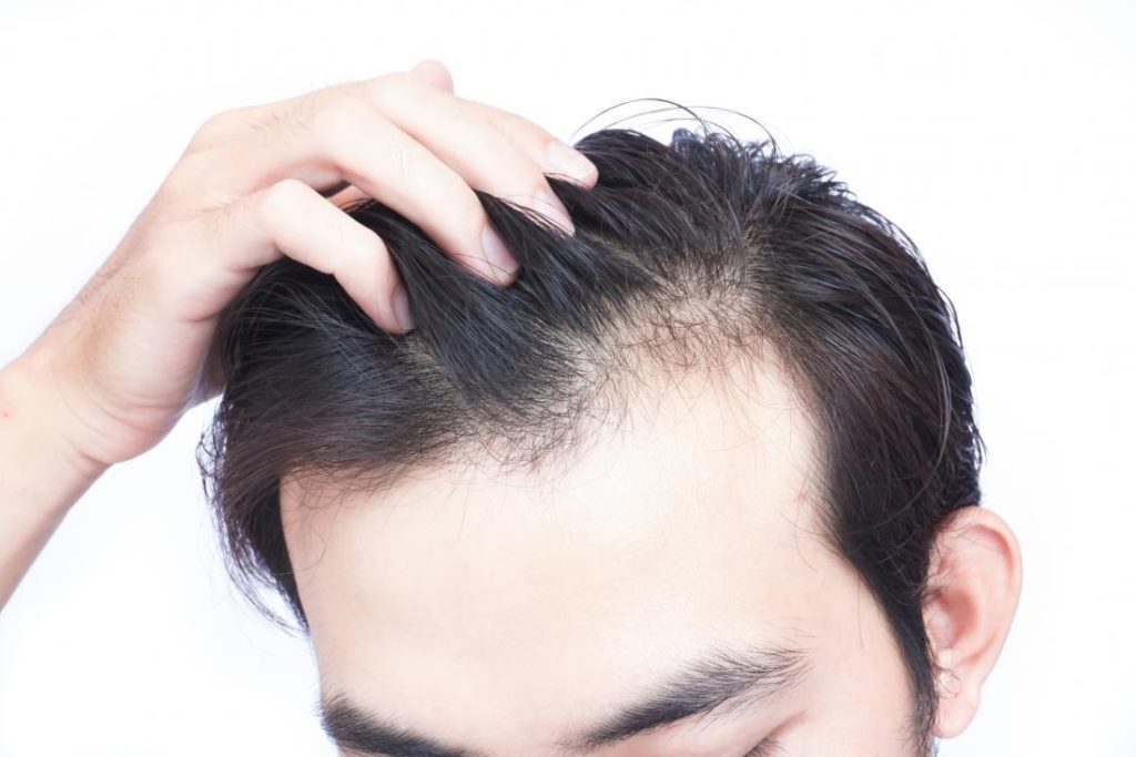 Man Start Getting Hair Loss