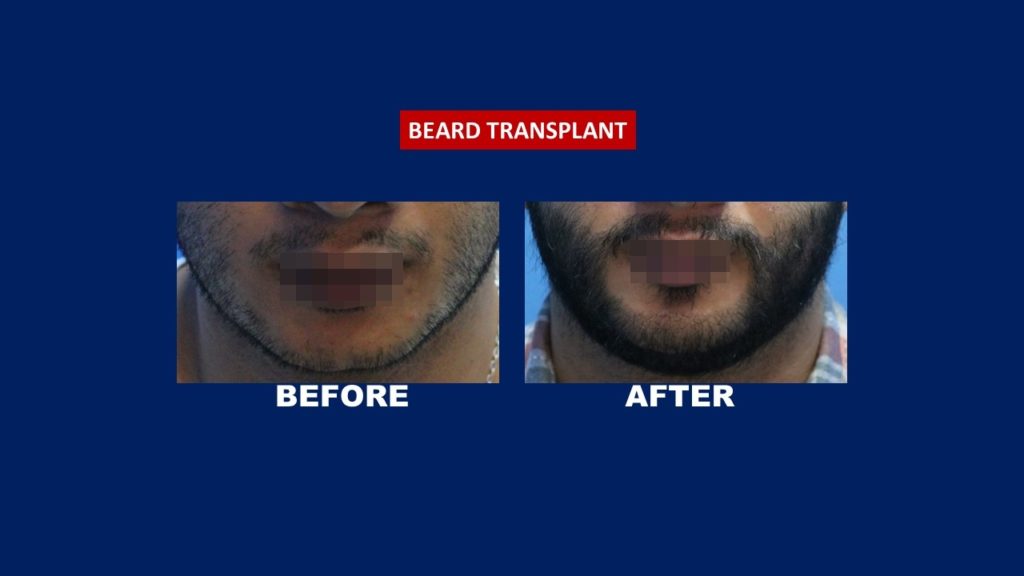 beard transplant result before and after