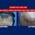 Before and after result for corrective hair transplant services treatment