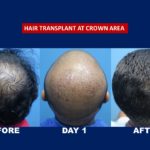 result for crown hair transplant