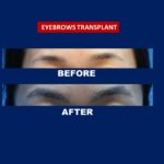 eyebrow transplant treatment services