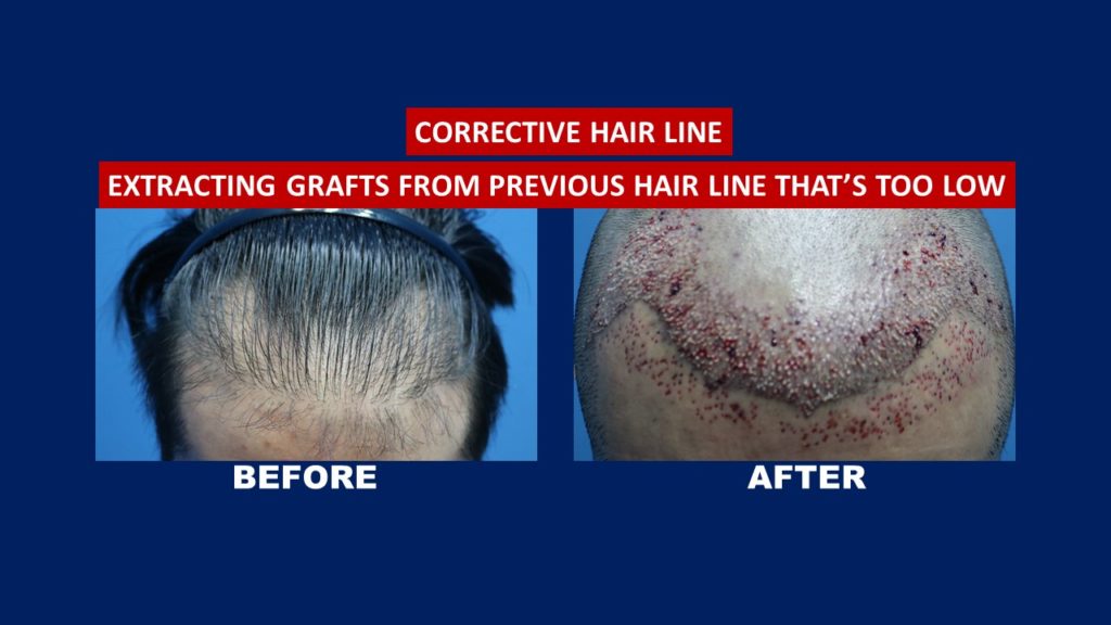 corrective hair transplant before and after