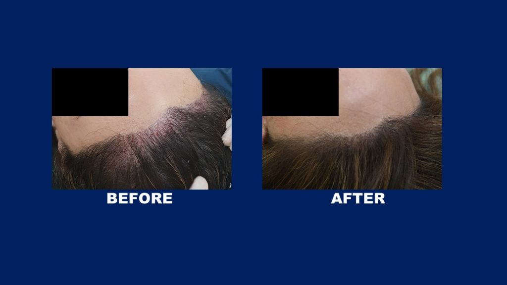 Lowering Hair Line Result Treatment