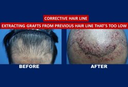 corrective hair transplant before and after Before and after result for corrective hair transplant services treatment